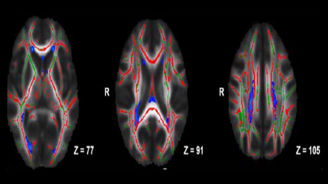Pediatric MS Disruption of white matter tracts and presence of lesions in MS image